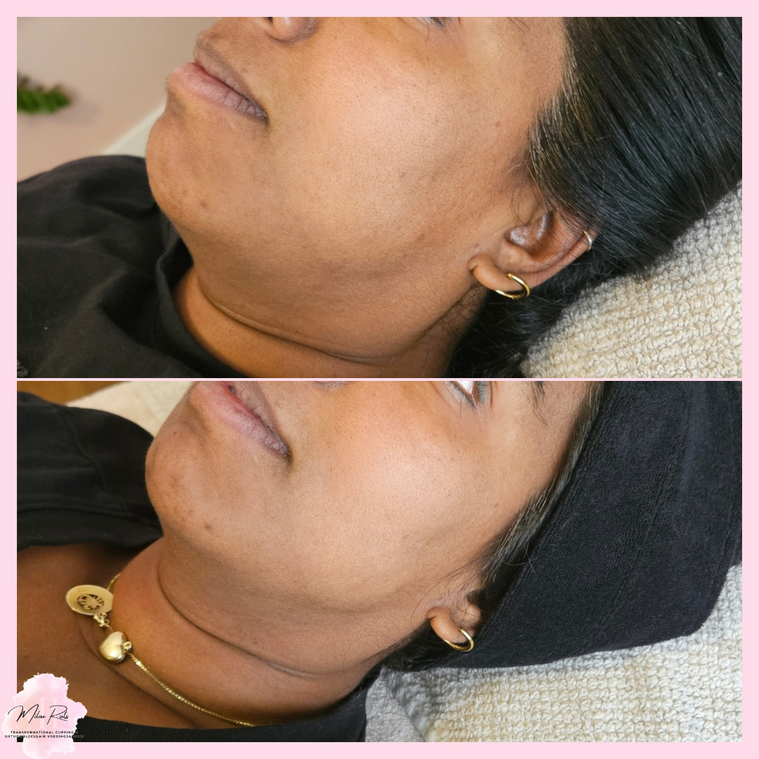 Gezichtsbehandeling resultaat 1